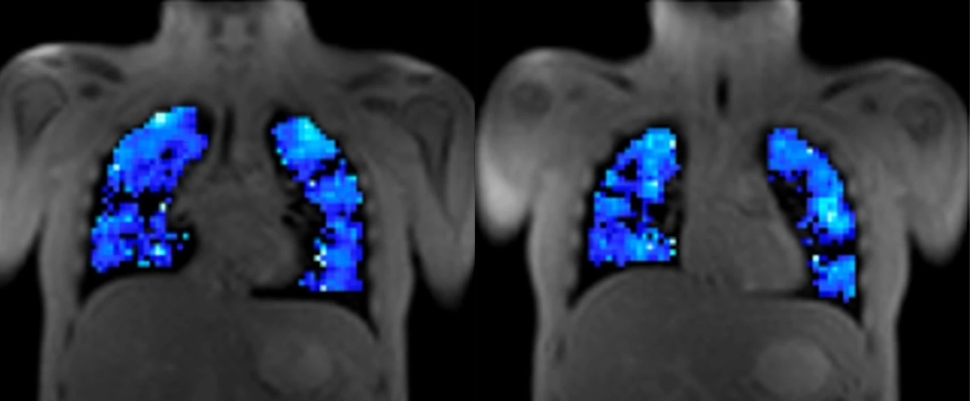 Ventilation maps from coronal slices in a cystic fibrosis patient