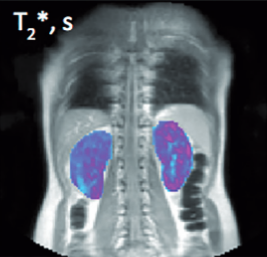 Kidney T2* map in lupus nephritis