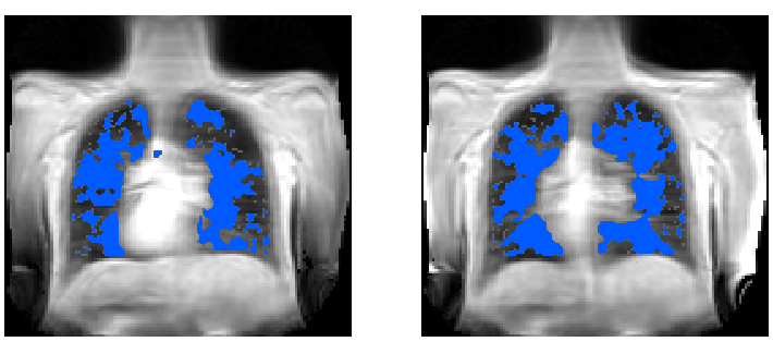 Evaluation of dynamic contrast-enhanced MRI measures of lung congestion and endothelial permeability in heart failure: a prospective method validation study